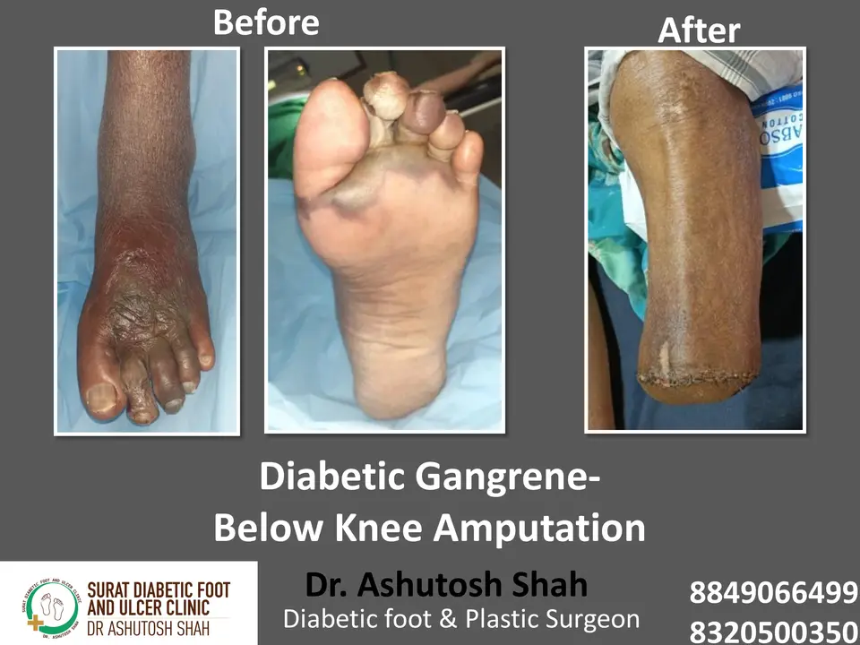 Diabetic Foot  PPT sunita.pptx-21.webp